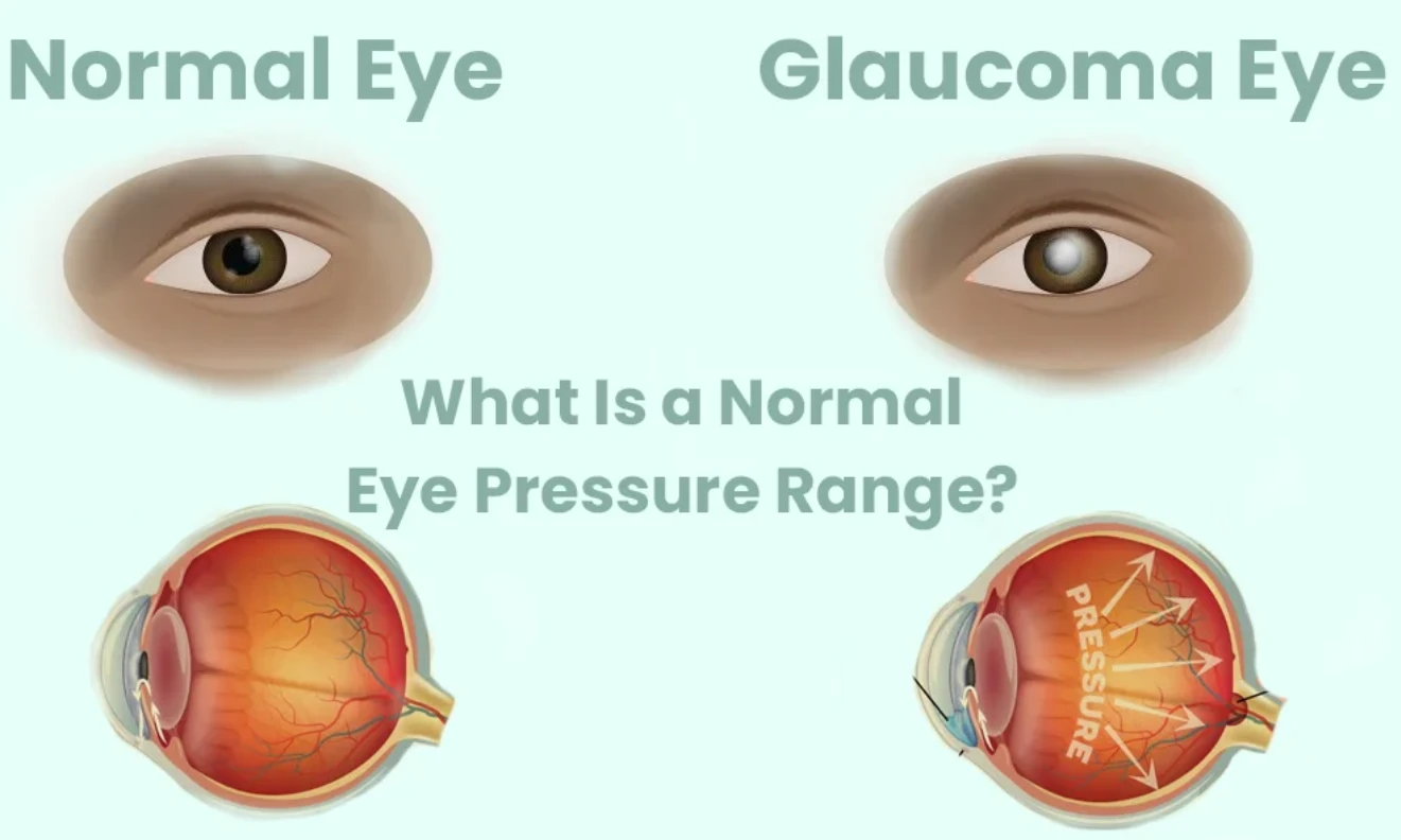 Exploring the Range of Normal Eye Pressure