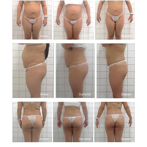 Cool cold vacuum portable cryolipolyse machin