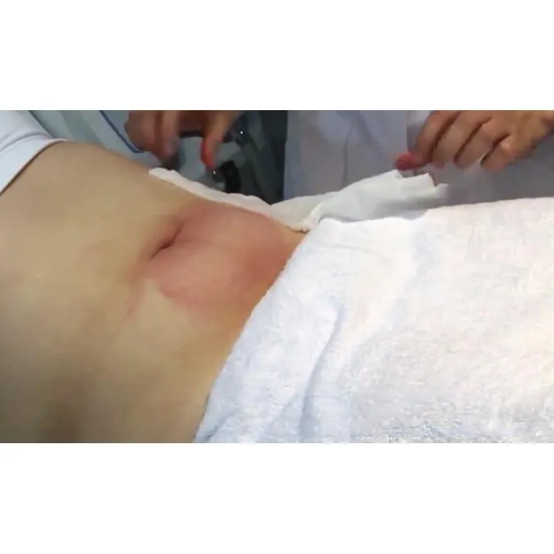 Cool Tech Frozen Cool Freezing Slimming Cryolipolyse Machine