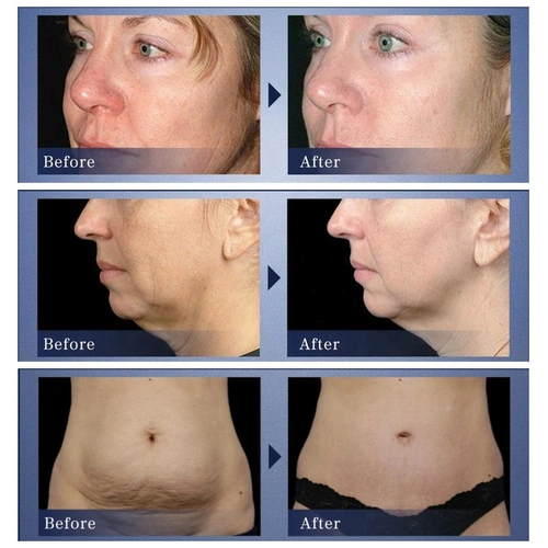 3 in 1 Ultrasonic RF Micro Electric Facial Beauty Machine 