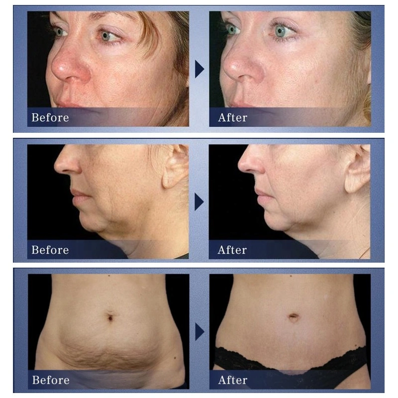 3 in 1 Ultrasonic RF Micro Electric Facial Beauty Machine 