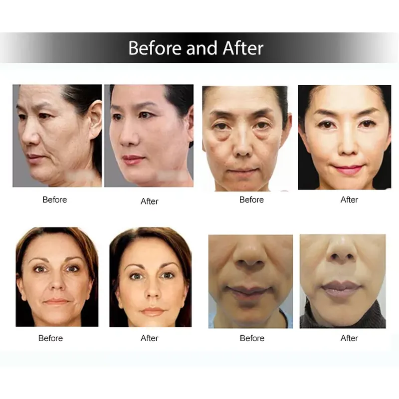 Fractional Rf Micro Needle Machine Fractional RF Microneedle Machine 