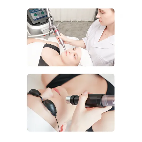 Unique Pico Laser Freckle Removal Tattoo Removal Birth Mark 