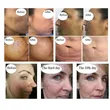  Excellent Fractional Scar Removal Skin Care Face Lifting Equipment