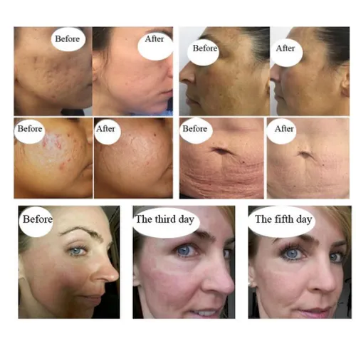  Excellent Fractional Scar Removal Skin Care Face Lifting Equipment