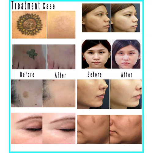 755 nm Pico laser / Picolaser /Portable Picosecond laser