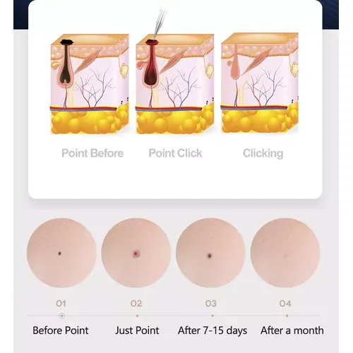 Laser Plasma Pen Skin Tag Tattoo Removal Device 