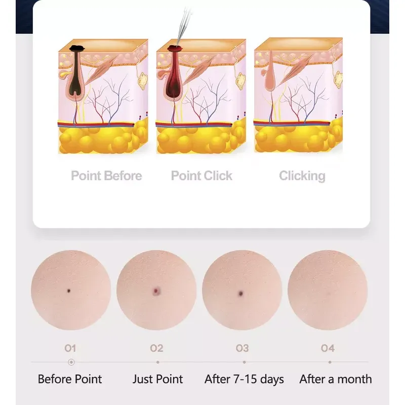 Laser Plasma Pen Skin Tag Tattoo Removal Device 