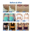 cryo lipolysis weight loss cellulite removal body slimming