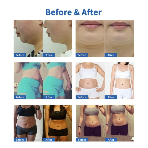 cryo lipolysis weight loss cellulite removal body slimming