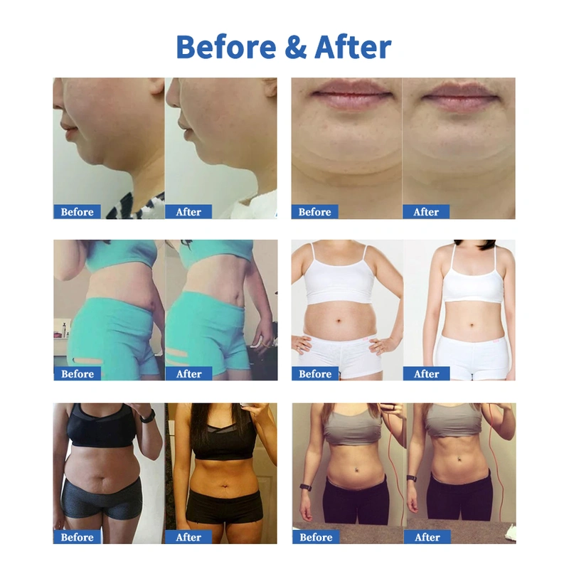 cryo lipolysis weight loss cellulite removal body slimming