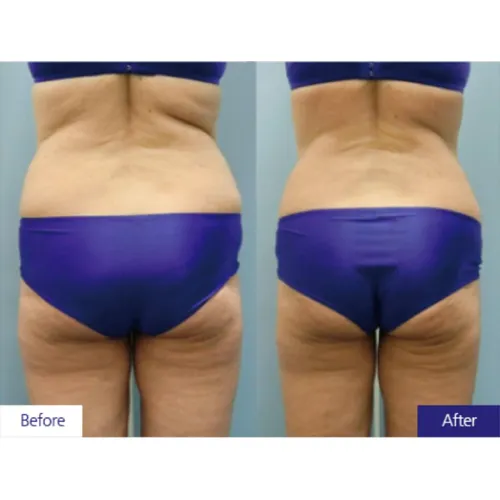 Professional Cryolipolysis rf Slimming Cryo Plate 