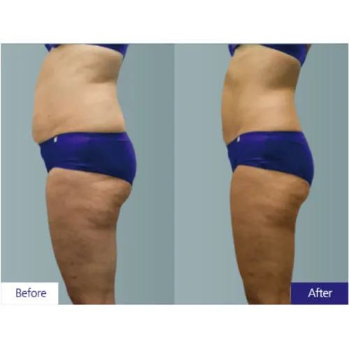 Professional Cryolipolysis rf Slimming Cryo Plate 