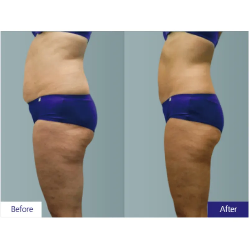 Professional Cryolipolysis rf Slimming Cryo Plate 