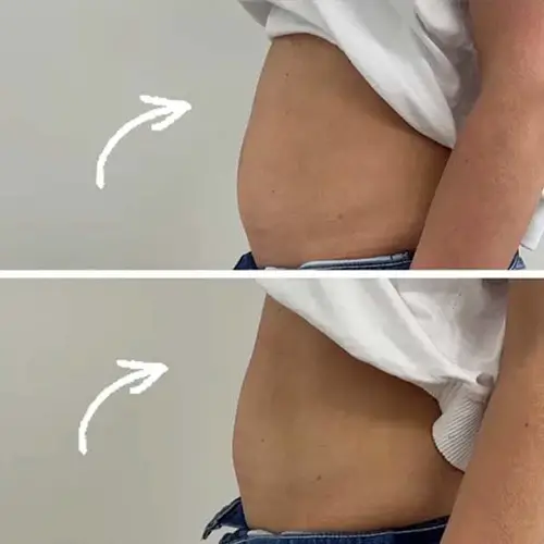 Professional Vertical Cryotherapy cooling RF microcurrent