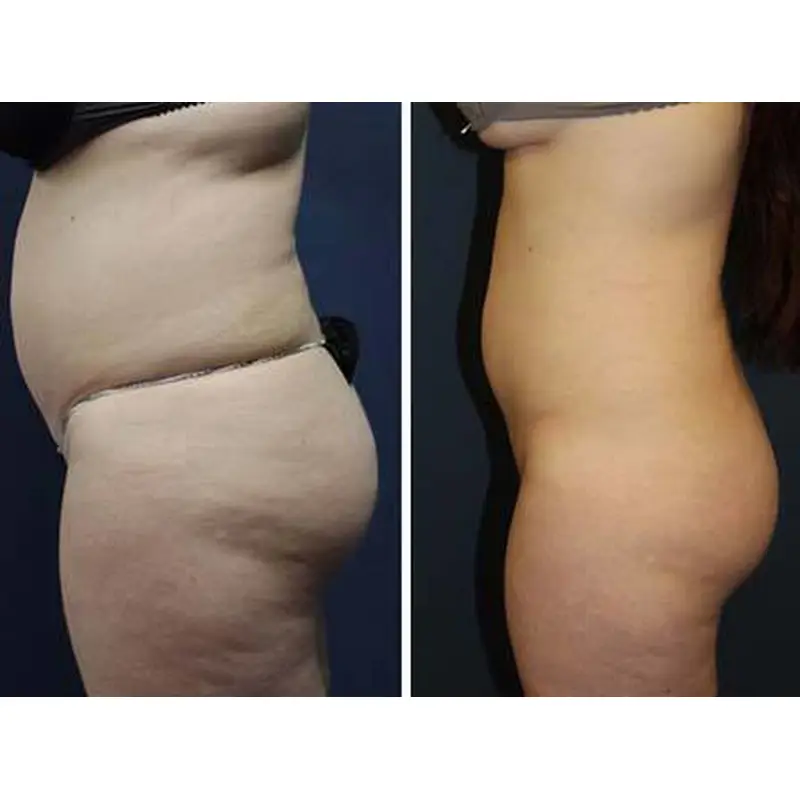 Professional Vertical Cryotherapy cooling RF microcurrent