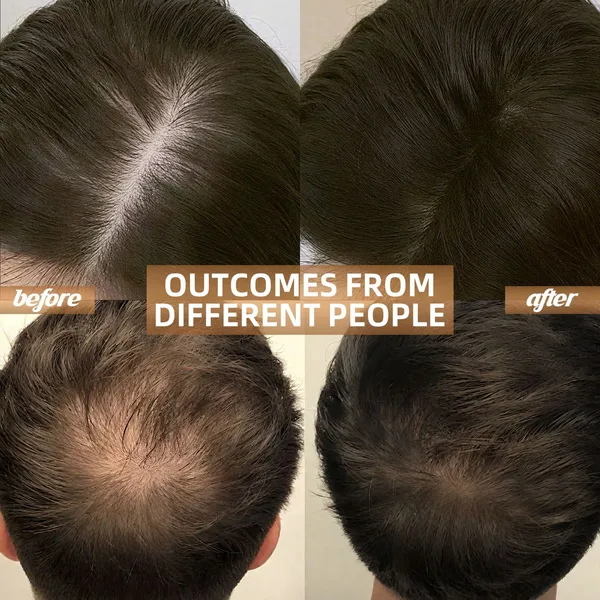 Cordless Red Light Therapy for Hair Growth Cap, Infrared Red Light Therapy to Support Scalp Health, Reduce Hair Loss & Shedding