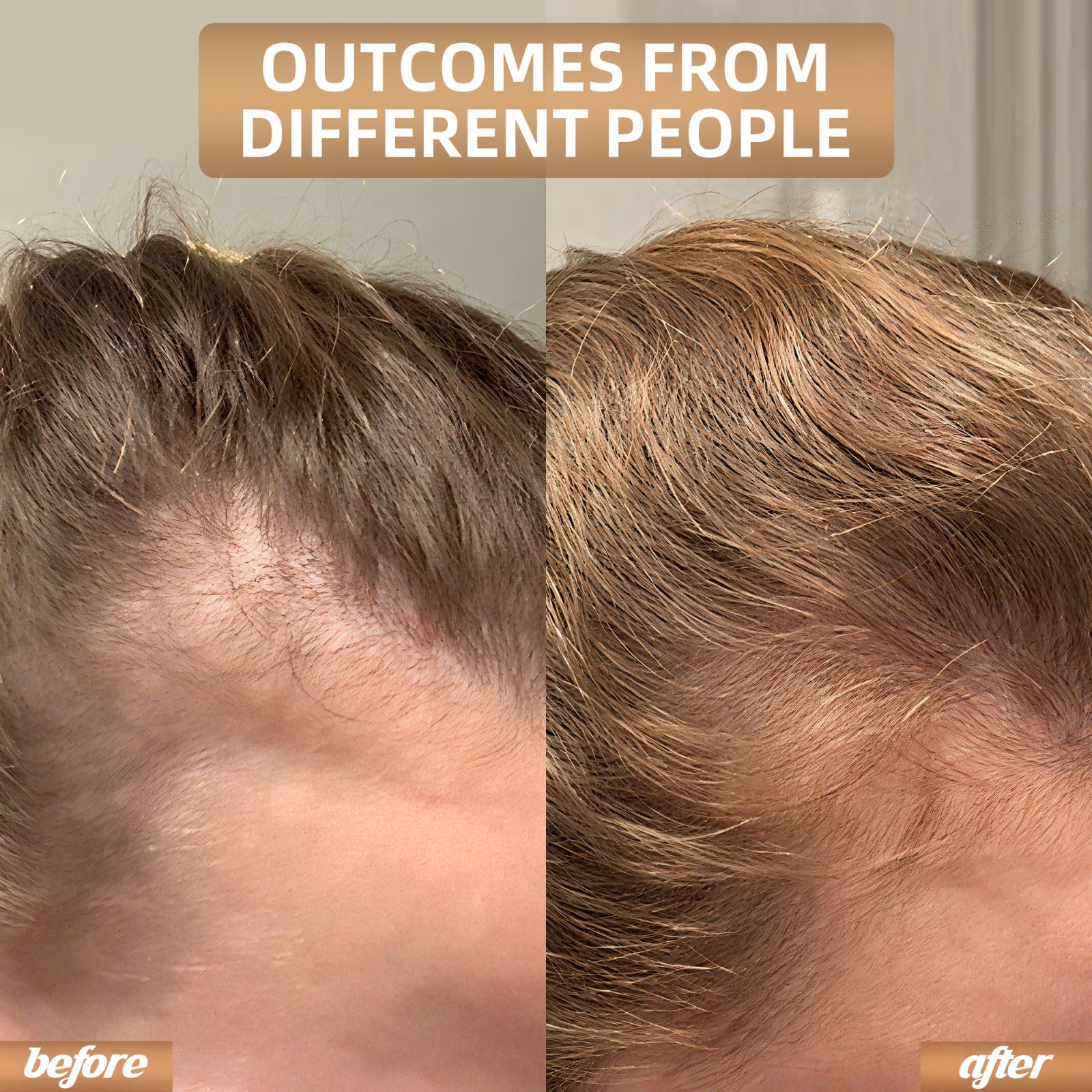 Cordless Red Light Therapy for Hair Growth Cap, Infrared Red Light Therapy to Support Scalp Health, Reduce Hair Loss & Shedding