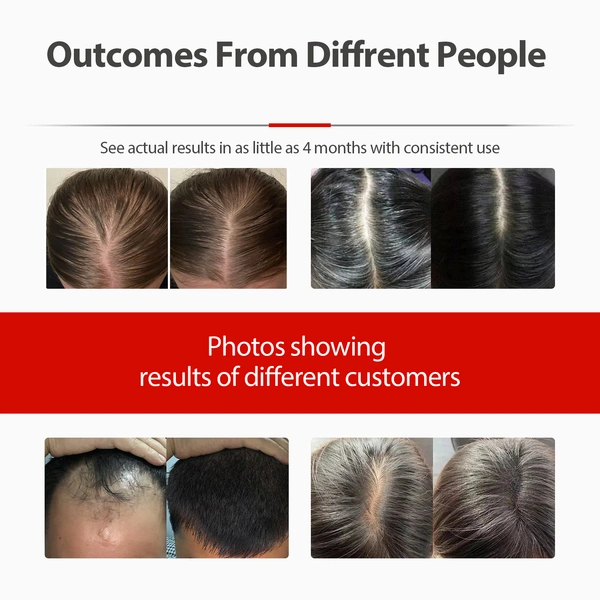 Laser Hair Growth Cap, Red Light Therapy for Hair Regrowth, Laser Therapy Cap for Hair Loss, Hair Loss Treatments Hat for Men & Women