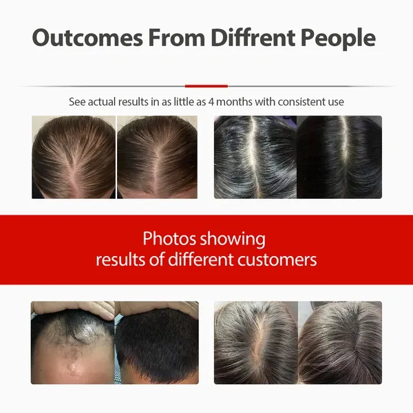 Laser Hair Growth Cap, Red Light Therapy for Hair Regrowth, Laser Therapy Cap for Hair Loss, Hair Loss Treatments Hat for Men & Women