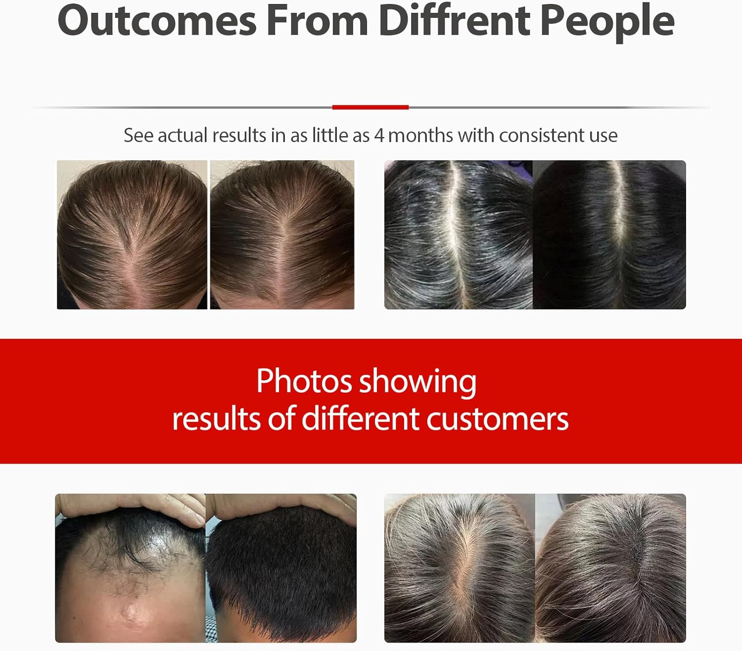 Laser Cap,Red Light Therapy for Hair Growth,Hair Loss Treatments Hat for Men & Women, with Built-in Battery & Controller