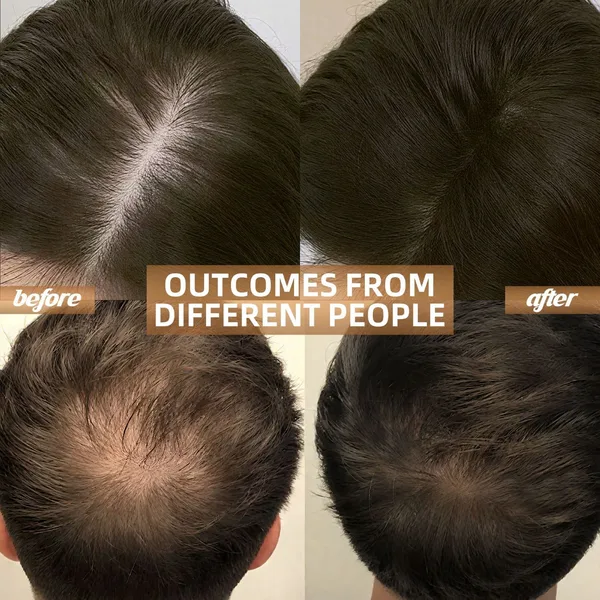Red Light Therapy for Hair Growth
