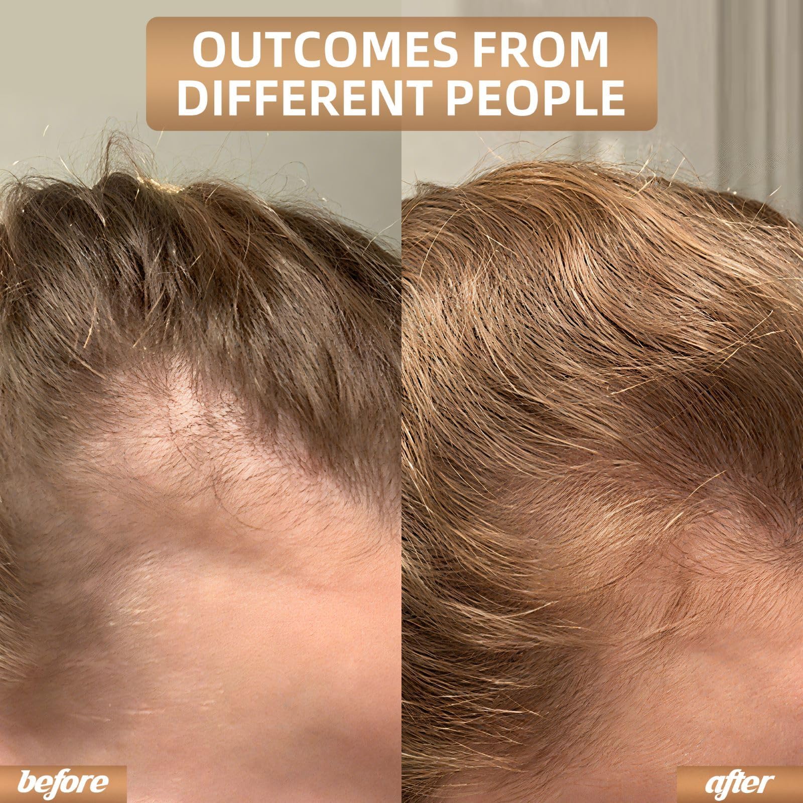 Red Light Therapy for Hair Growth