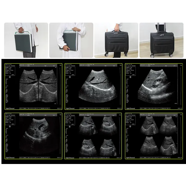 Cheapest Sedan Digital Ultrasound Machine LX-BW-L1