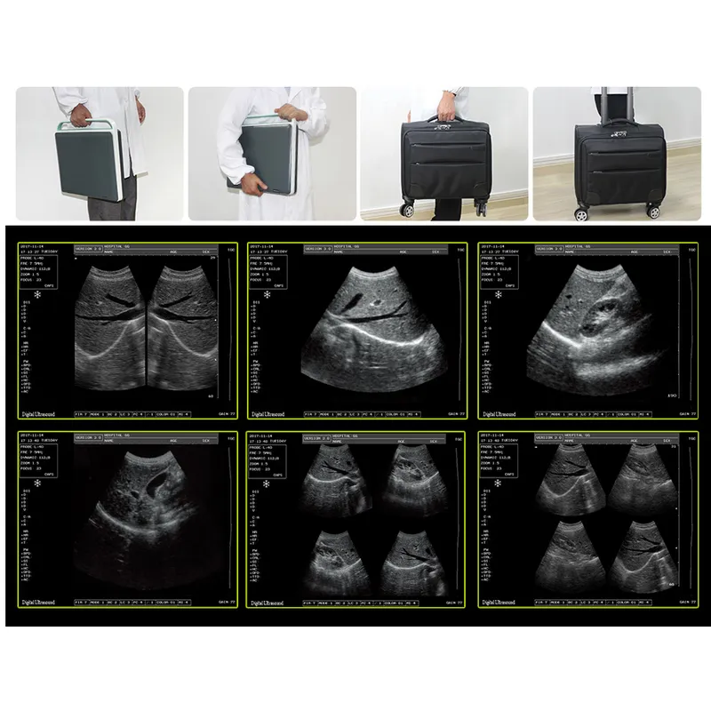 Cheapest Sedan Digital Ultrasound Machine LX-BW-L1