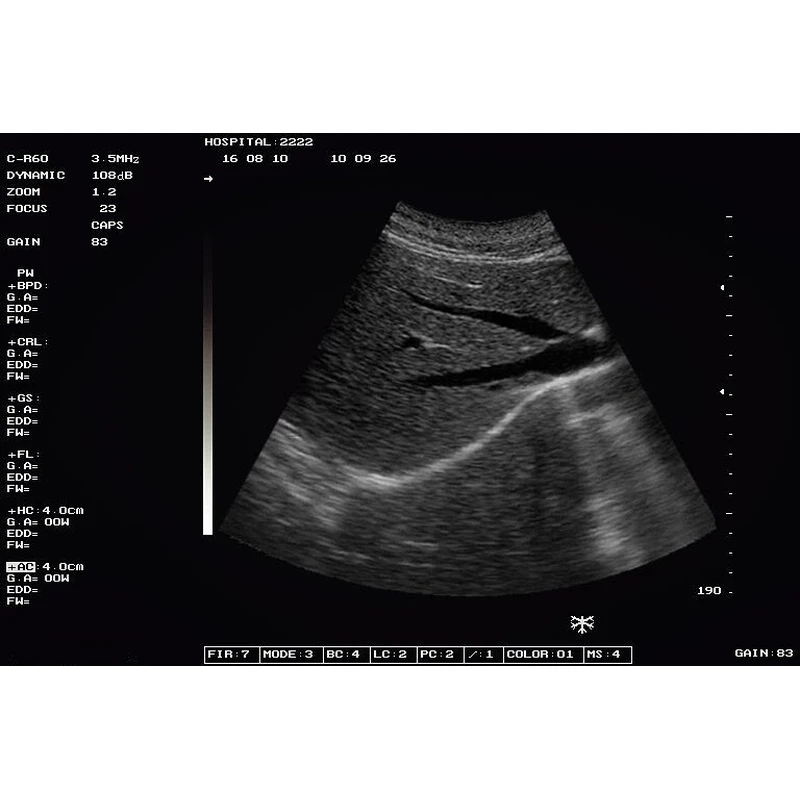 Hot sale CE Hospital Portable Black White Ultrasound machine Price  LX-BW-L2