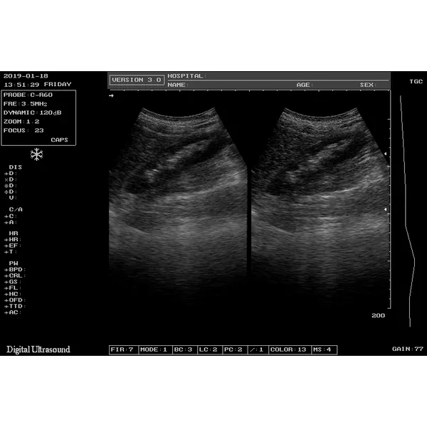 Cheapest Sedan Digital Ultrasound Machine LX-BW-L1