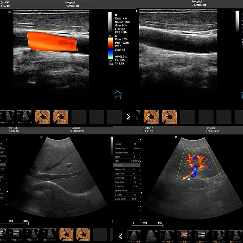 LX-CB-L2 B ULTRASOUND