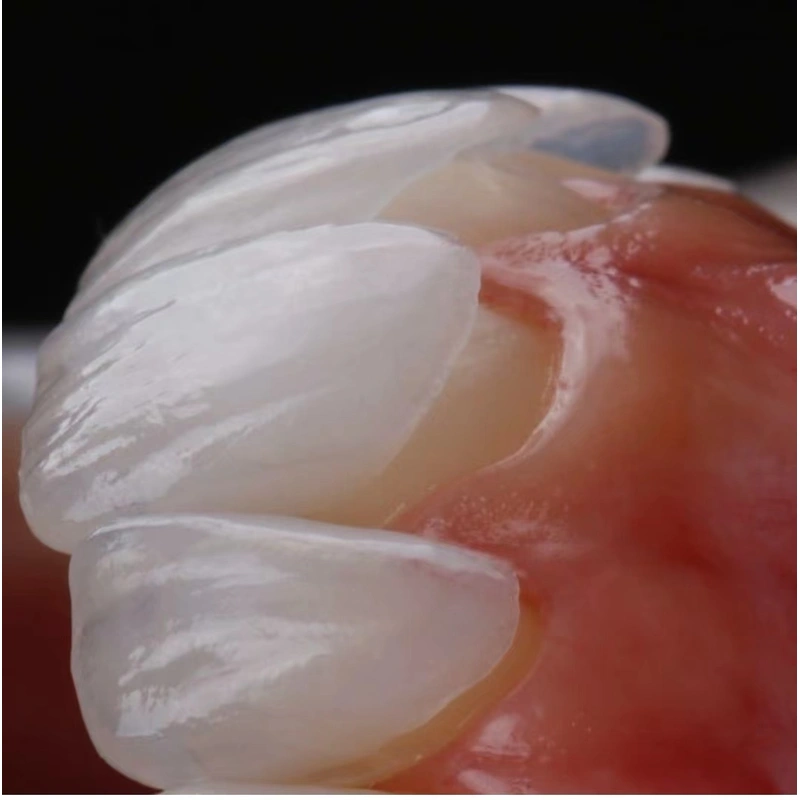 IPS EMAX VENEER MINIMAL PREP VENEERS