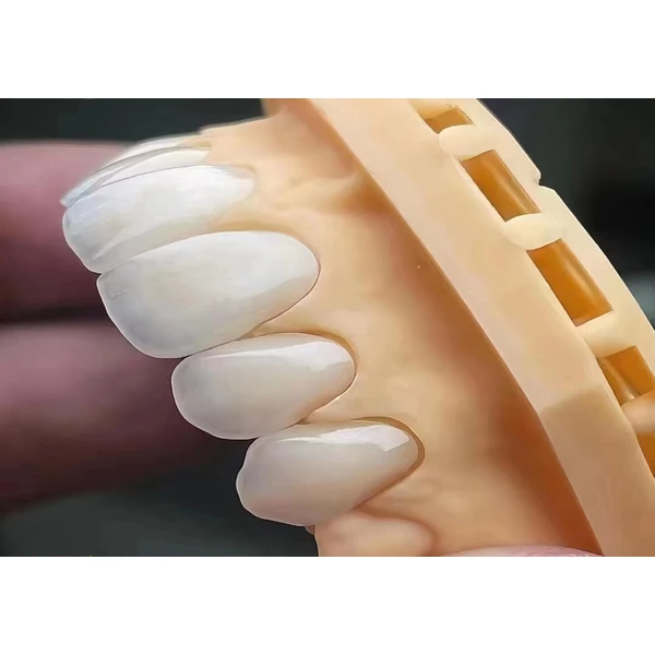 IPS EMAX VENEER MINIMAL PREP VENEERS