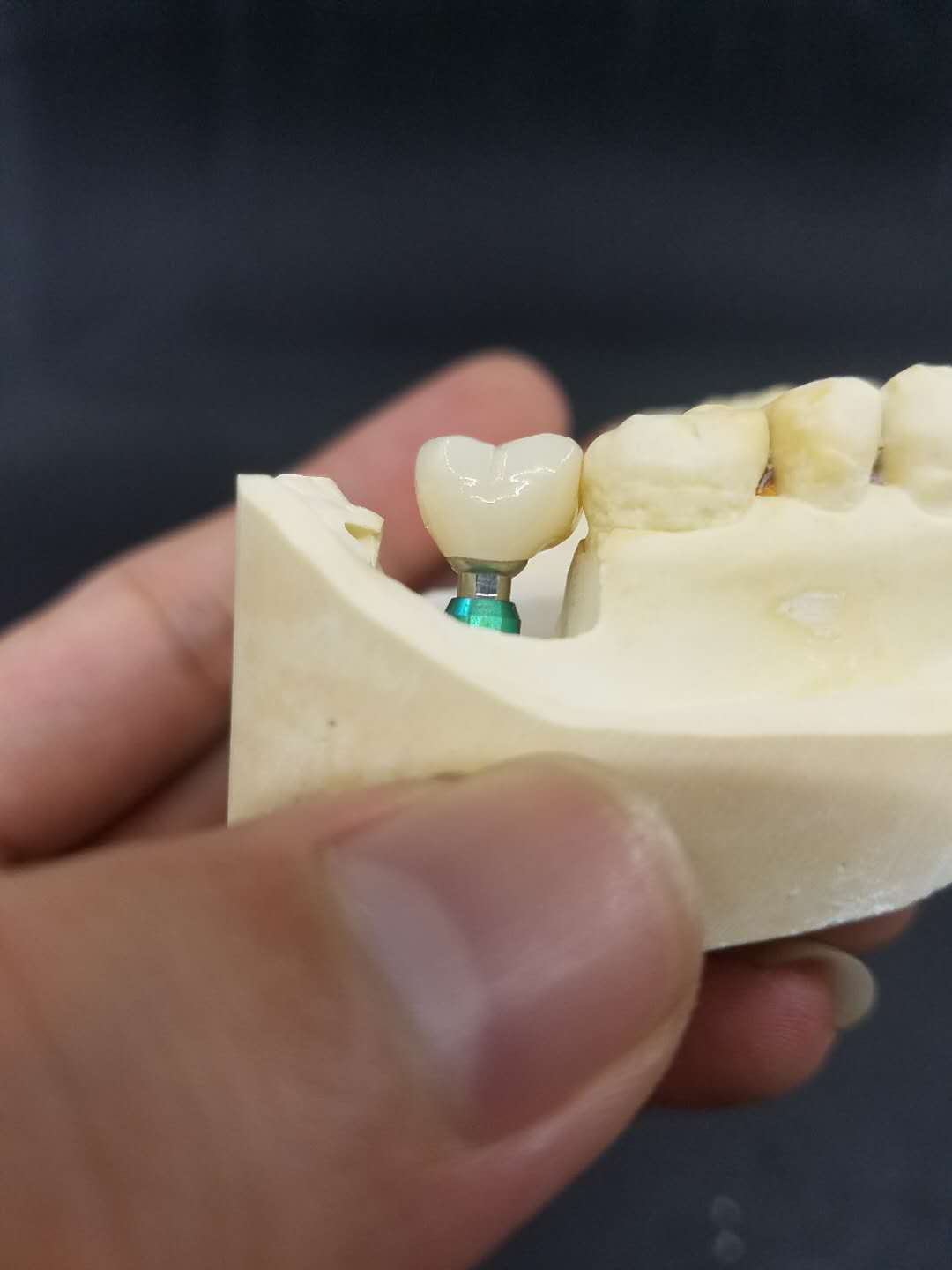 Cement implant Crown