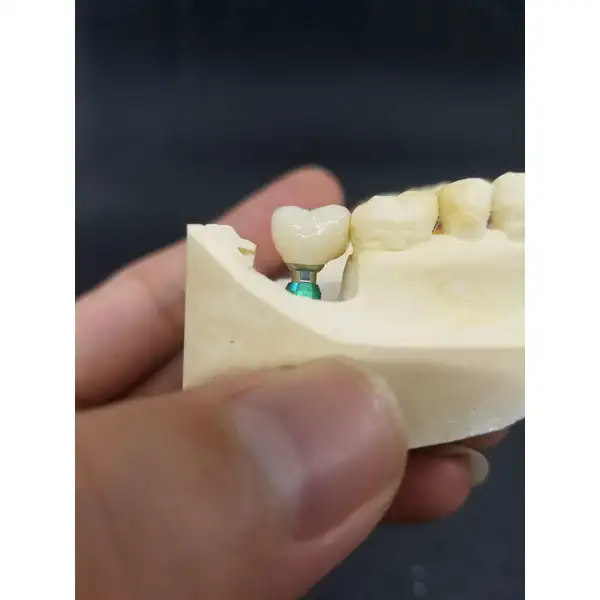 Cement implant Crown