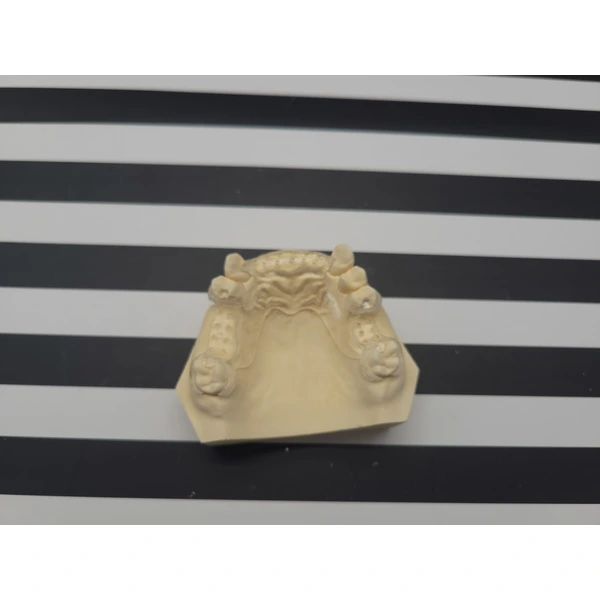 Clear Framework Denture