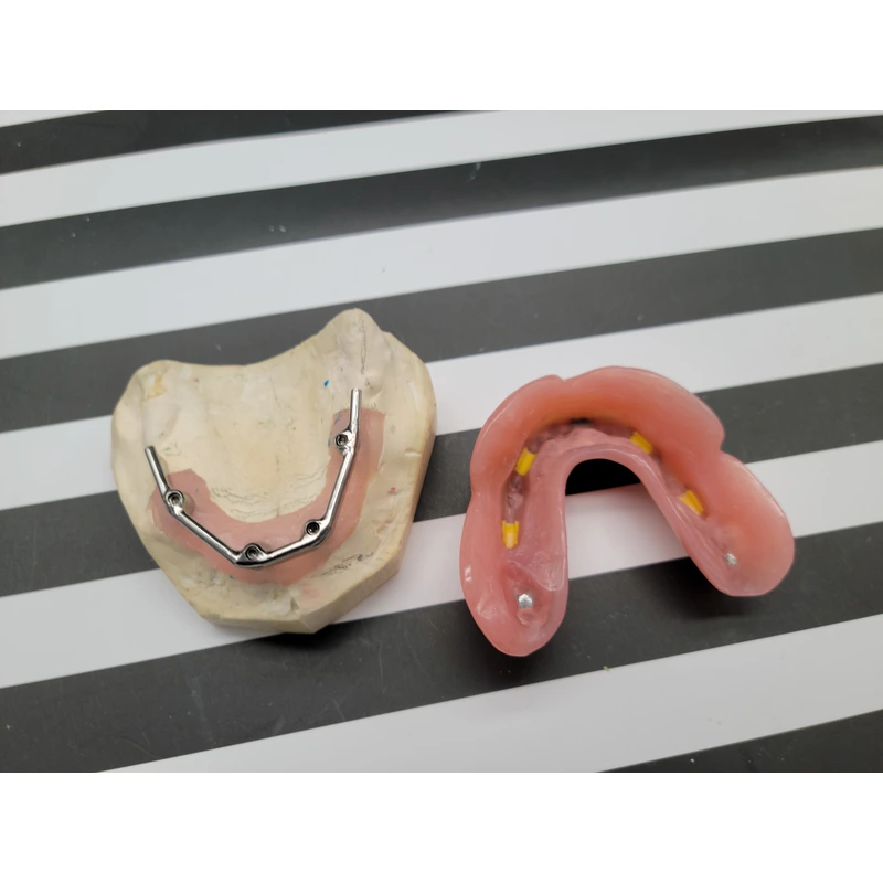Implant-Supported Removable Denture