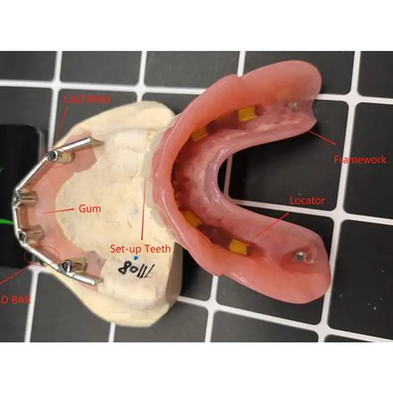 Implant-Supported Removable Denture